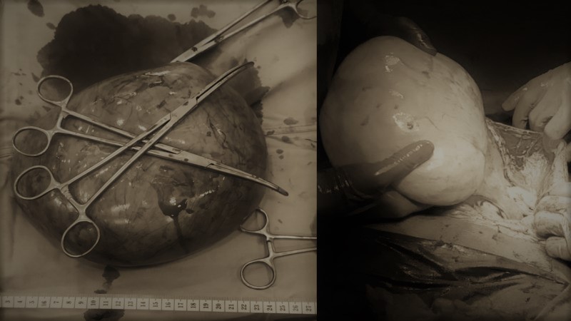 Removal of a 2.4kg cyst successful in KRH